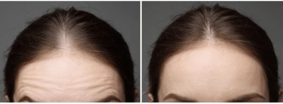 Botox Before and After Jupiter FL