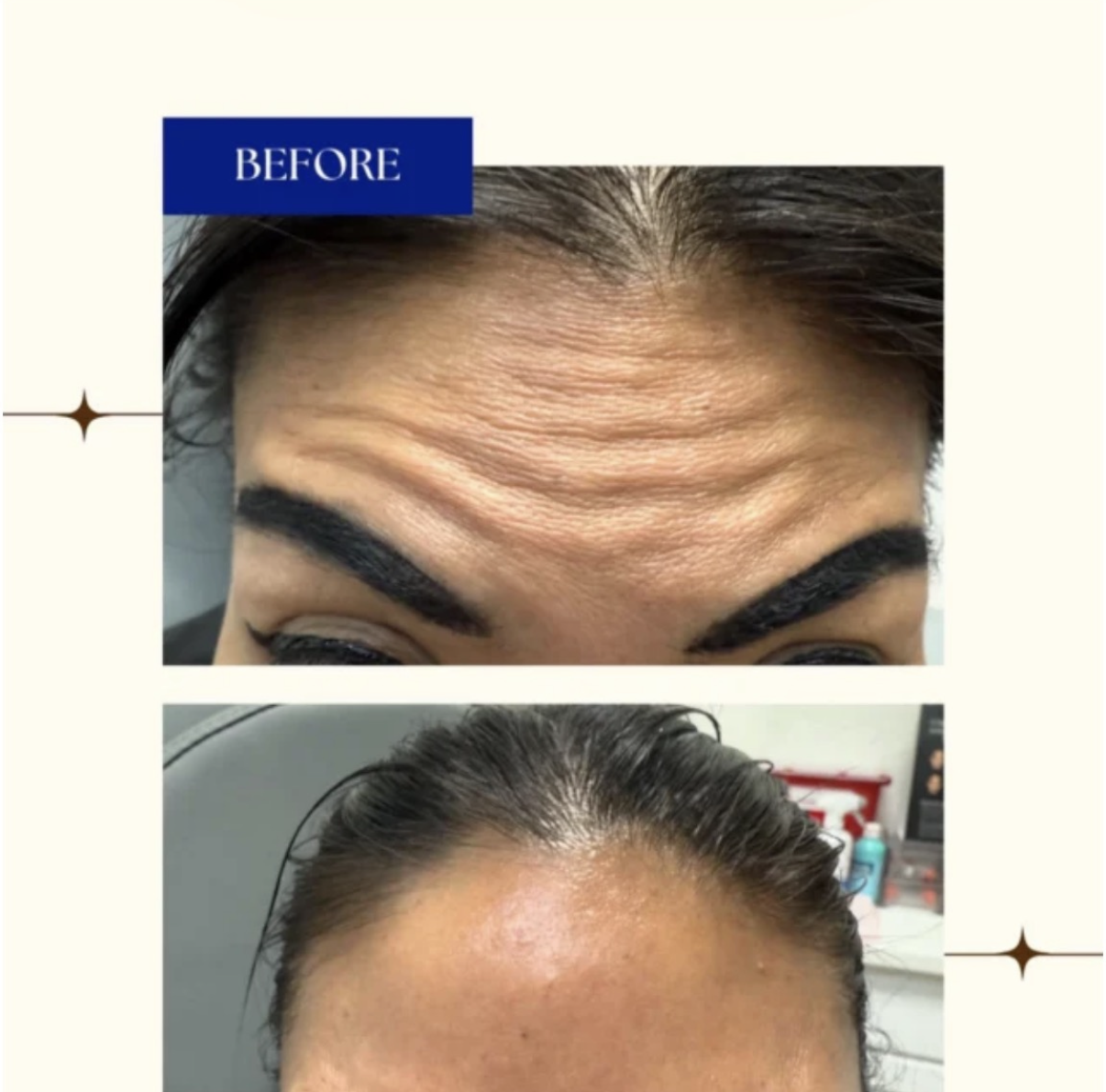 Botox Cosmetic Before and After Jupiter Florida