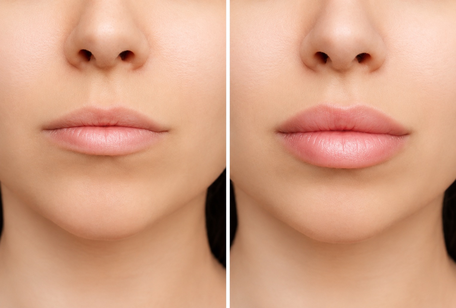 Lip Enhancement Before and After Jupiter FL
